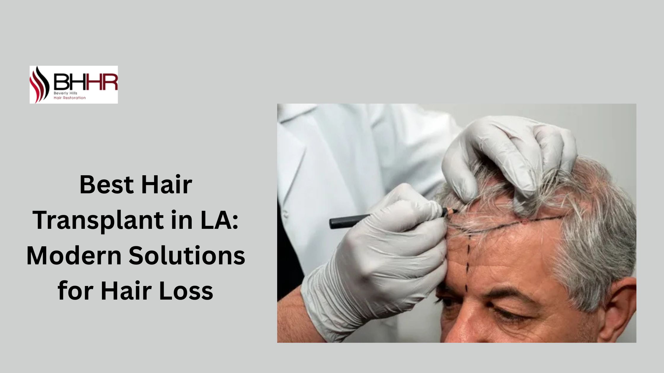 Best-Hair-Transplant-in-LA-Modern-Solutions-for-Hair-Loss