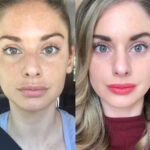 Radiofrequency-RF-Microneedling-in-Dubai-1