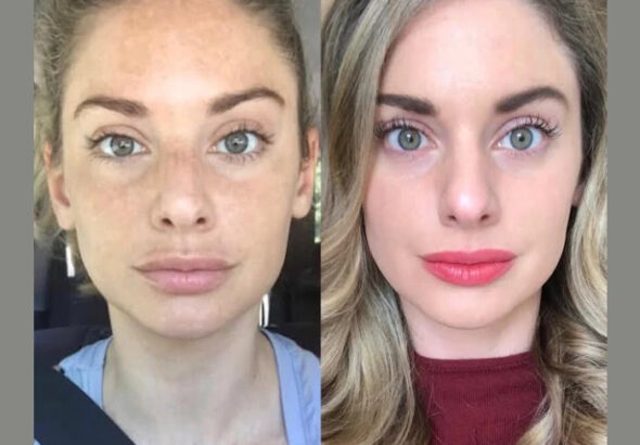Radiofrequency-RF-Microneedling-in-Dubai-1