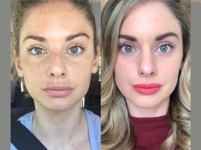 Radiofrequency-RF-Microneedling-in-Dubai