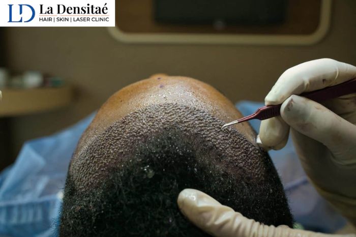 Why-Bangalore-Professionals-Are-Choosing-La-Densitae-for-Hair-Transplant-Over-Local-Clinics