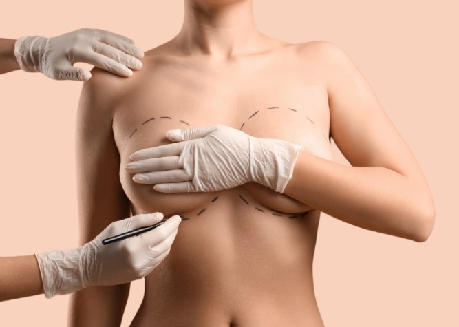 breast-augmentation