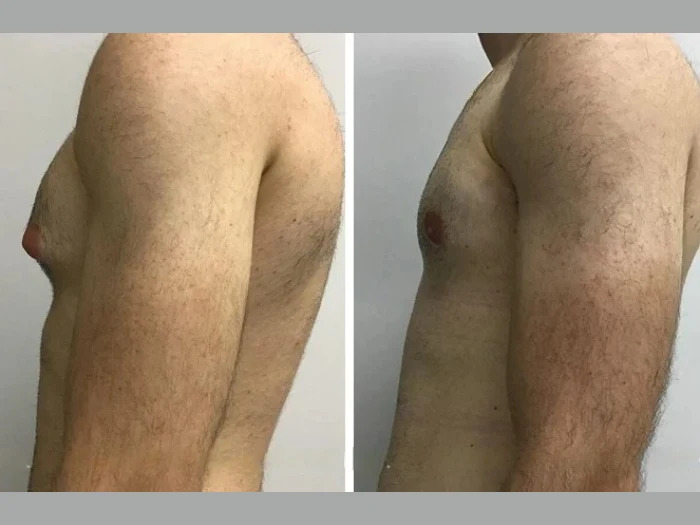 h9-gynecomastia-1