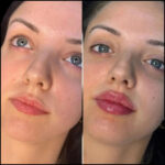 FILLERS-IN-DUBAI-1_optimized_100
