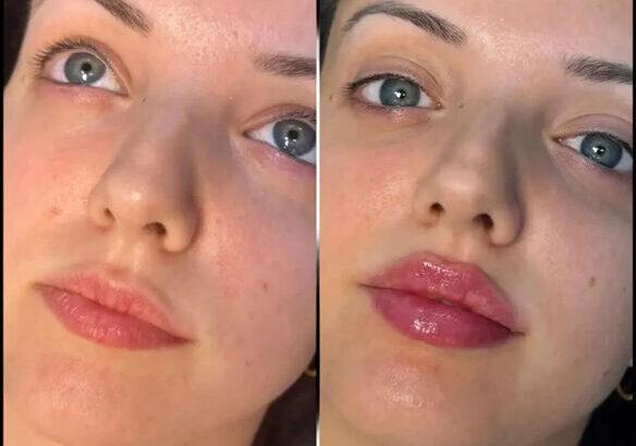 FILLERS-IN-DUBAI-1_optimized_100