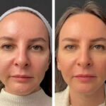 Mesotherapy-in-Dubai-1