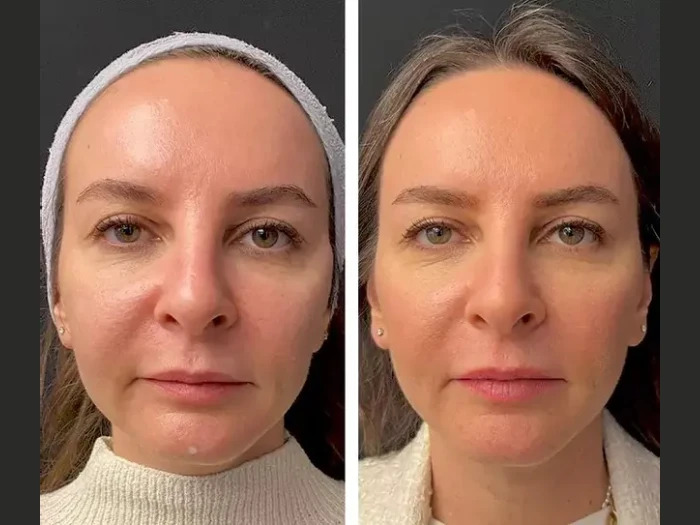 Mesotherapy-in-Dubai